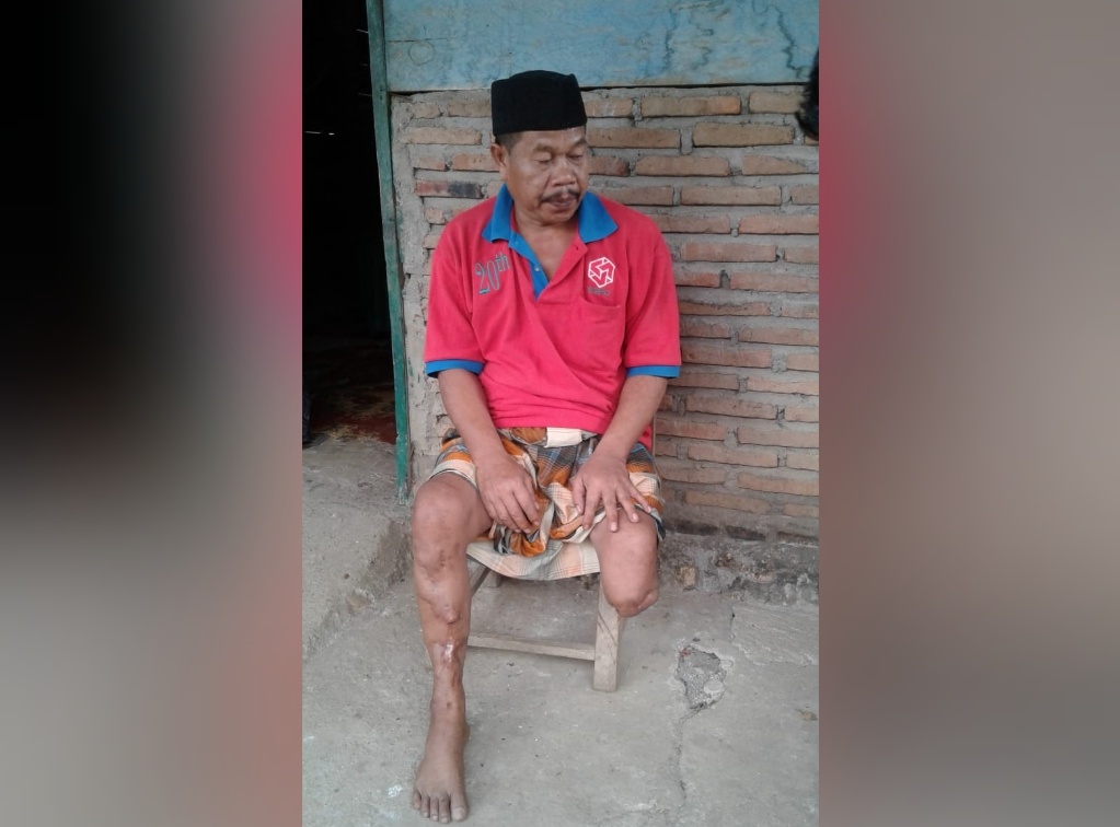 Conreng (48) penyandang disabilitas di Bulo bulo, Kecamatan Bulukumpa, Kabupaten Bulukumba, (foto: Parawansah)