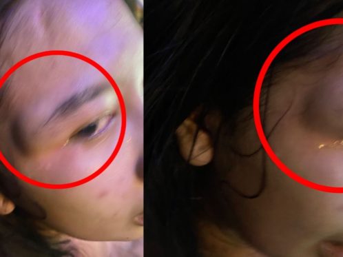 Wanita di Sidrap Dianiaya Hingga Wajah Bengkak, Pelaku Masih Bebas Berkeliaran: Ada Apa dengan Polres Sidrap?